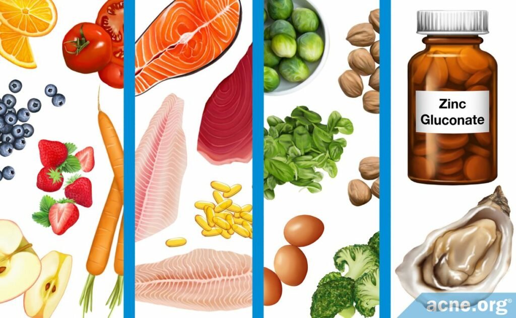 Does Diet Cause Acne