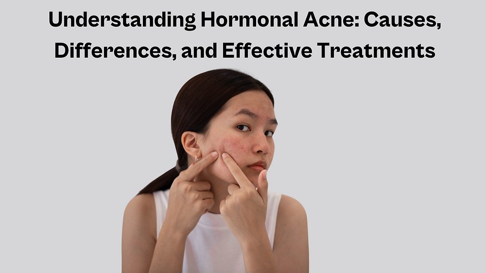 Hormonal Acne in Adults