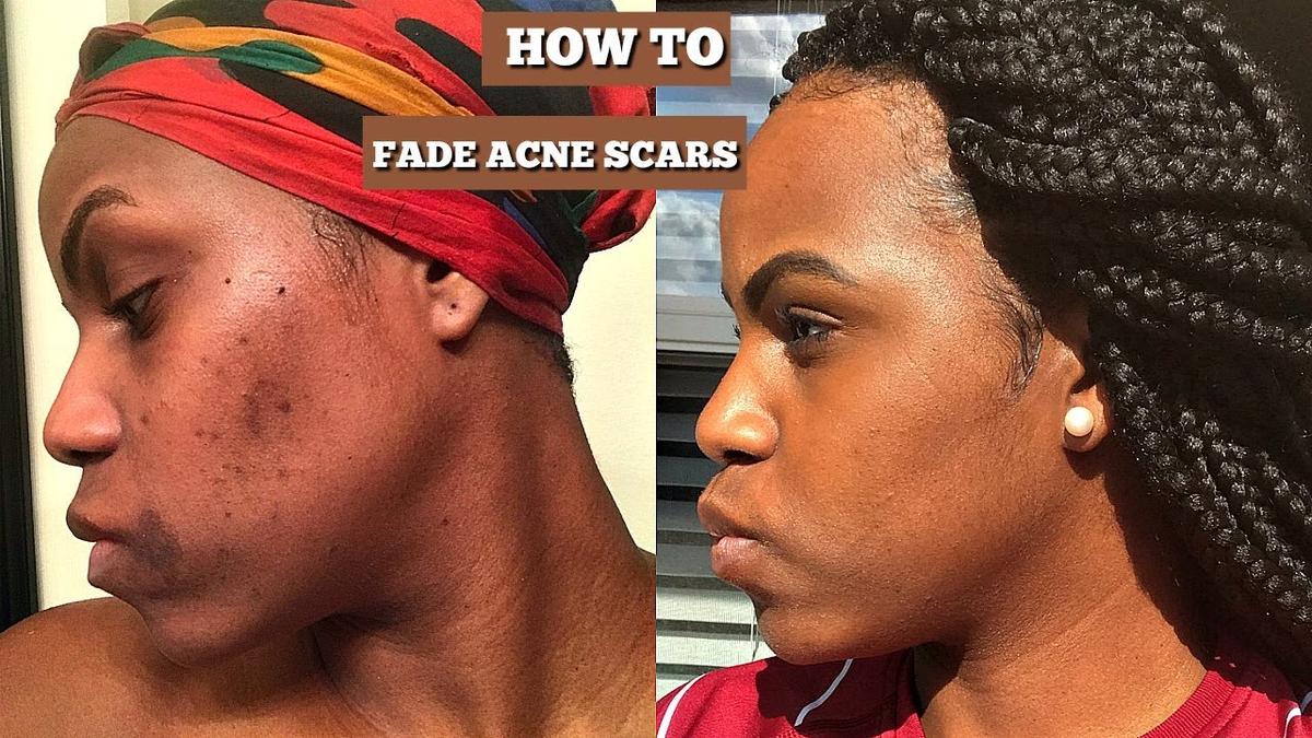 Fade Acne Scars and Hyperpigmentation
